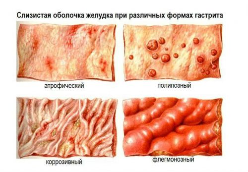 Формы гастрита