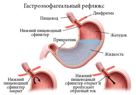 Гастроэзофагеальный рефлюкс