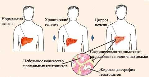 Хронический алкогольный гепатит