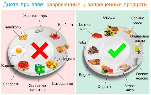 Питание при язве двенадцатиперстной кишки