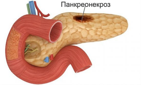 Панкреонекроз