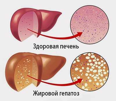 Жировой гепатоз печени