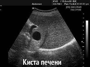 Киста печени на УЗИ