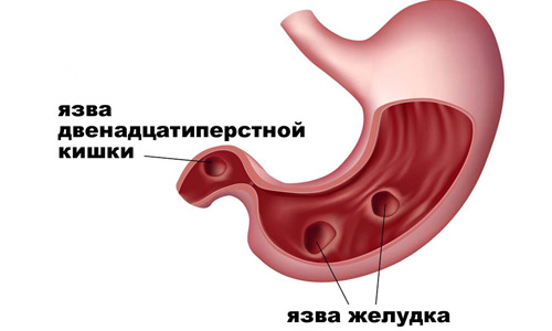 нервная язва