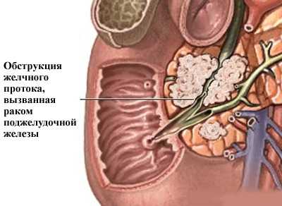 Обструкция желчевыводящих путей