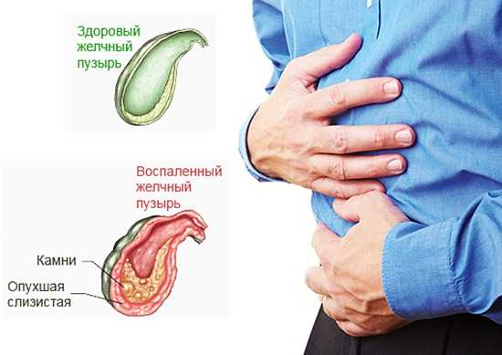 Симптомы острого холецистита