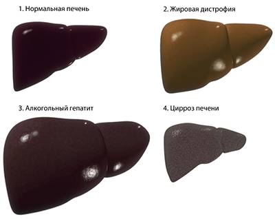 Поражения печени при алкоголизме