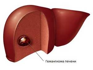Причины кавернозной гемангиомы печени
