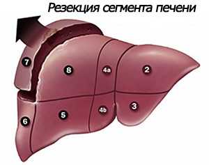 Резекция сегмента печени
