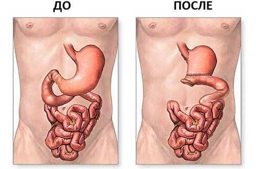 резекция желудка