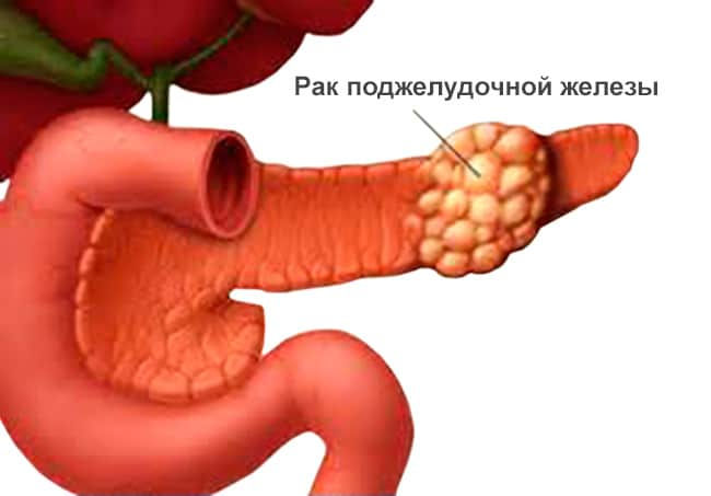 Рак поджелудочной