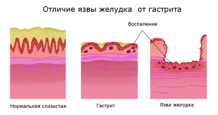 Чем отличается язва от гастрита