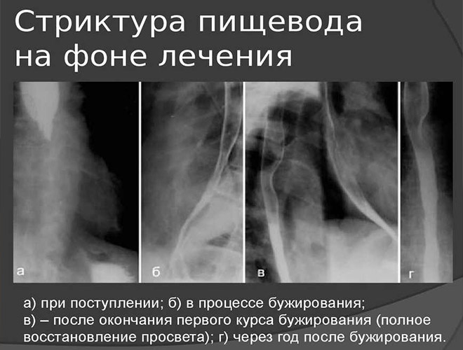 ГЭРБ: причины возникновения и клинические проявления