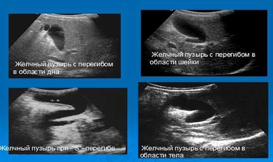 Варианты перегибов желчного пузыря на УЗИ