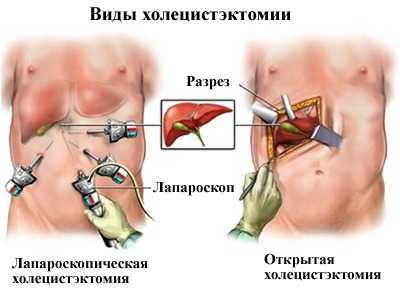 Виды холецистектомии