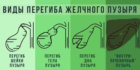 Виды перегибов желчного пузыря