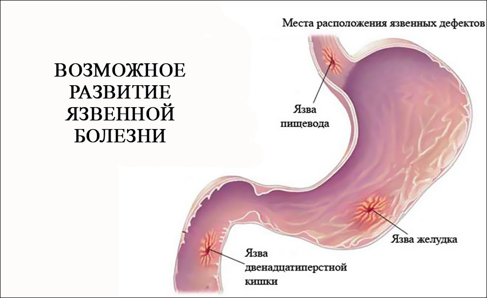 Возможное развитие язвенной болезни