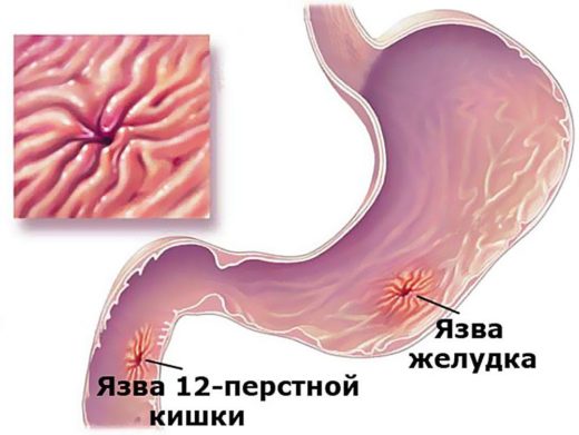 Язва двенадцатиперстной кишки