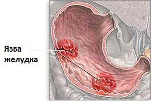 язва