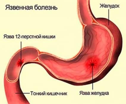 язва желудка и язва двенадцатиперстной кишки