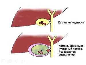 Закупорка желчного протока