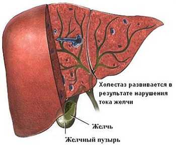 Застой желчи